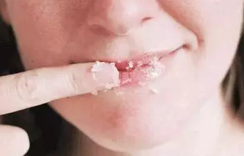  嘟嘴卖萌?麻烦先把唇部保养好再说 